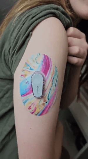 Girl with Shimmering Marble Dexcom G6 Tape on arm