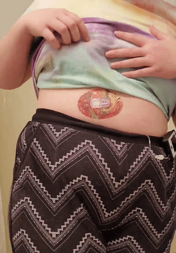 ExpressionMed Woman with rustic marble Dexcom G6 tape on stomach